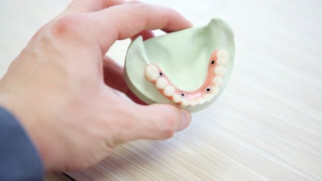 Dentadura fija sobre 4 implantes: precio y consideraciones