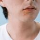 como se contagia el herpes labial
