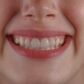 Cual es el precio de una corona dental y por que varia