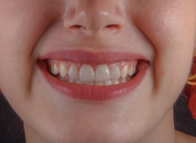 Cual es el precio de una corona dental y por que varia