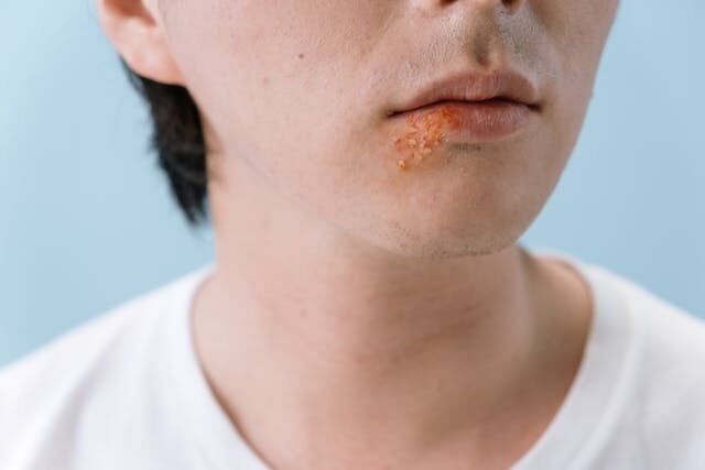 como se contagia el herpes labial