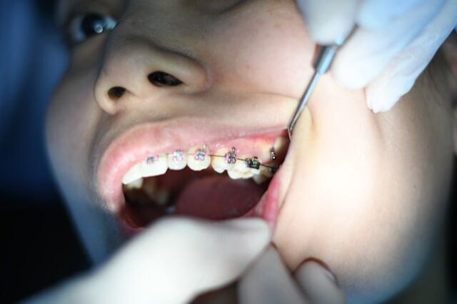 stripping dental