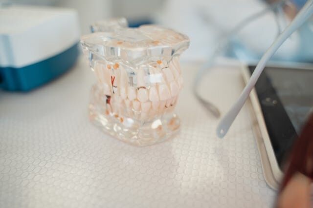Implantes Dentales sin Tornillos