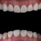 Fluorosis dental, que es grado y tratamiento segun la edad