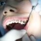 stripping dental