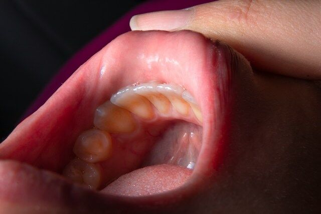 mucositis oral