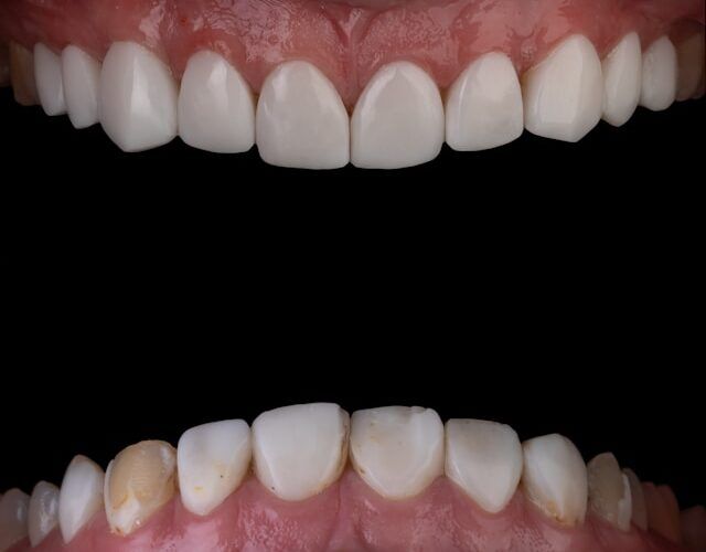 Fluorosis dental, que es grado y tratamiento segun la edad