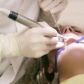 Quiste dental, qué es síntomas y tratamiento