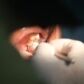 Fístula dental