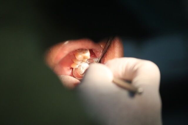 Fístula dental