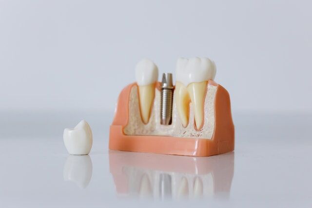 tipos de protesis dentales