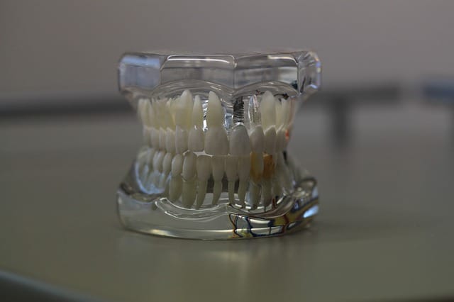 como se coloca un implante dental