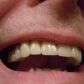 que es la hipoplasia del esmalte dental