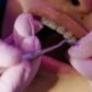 microimplantes dentales