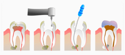 endodoncia en Salamanca